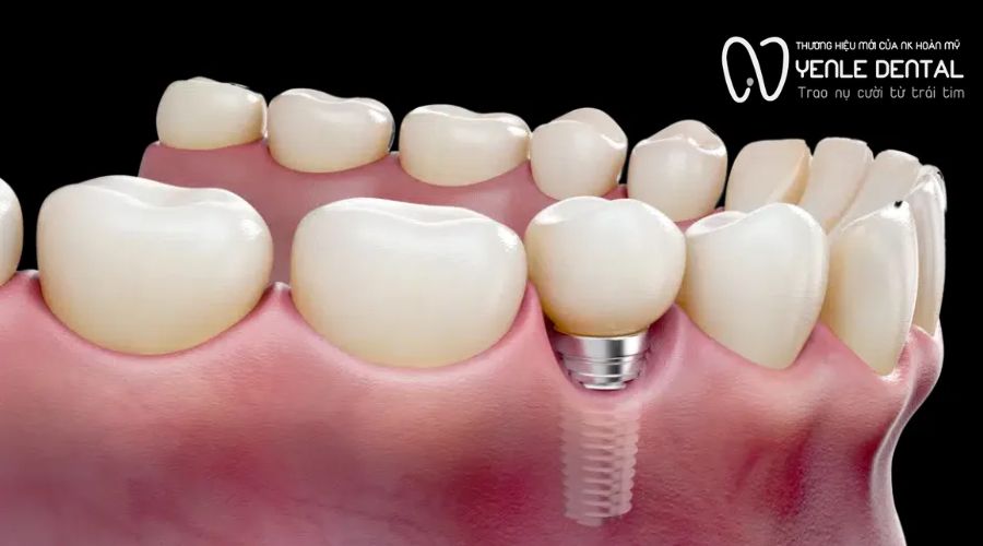trụ implant bị đào thải